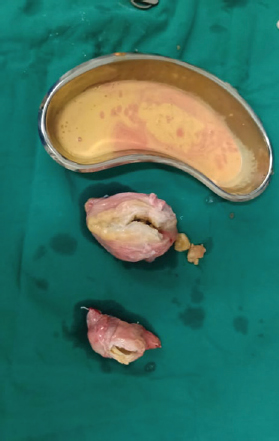 Postoperative specimen showing both testes with pyocele.